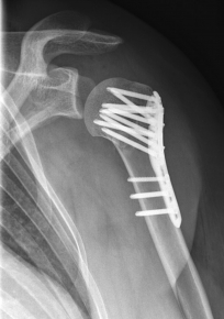 Proximaler Oberarmbruch6